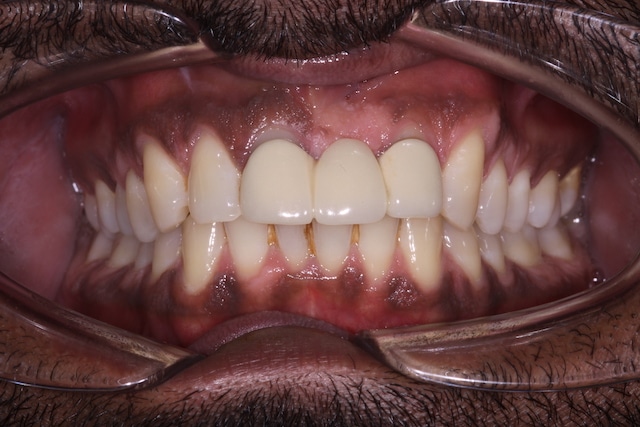 $variable({"type":"content","value":{"name":"post_title","settings":{"before":"","after":""}}})$ $variable({"type":"content","value":{"name":"post_title","settings":{"before":"","after":""}}})$