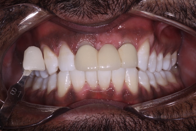 $variable({"type":"content","value":{"name":"post_title","settings":{"before":"","after":""}}})$ $variable({"type":"content","value":{"name":"post_title","settings":{"before":"","after":""}}})$