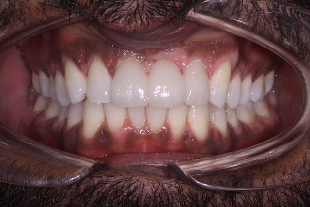 $variable({"type":"content","value":{"name":"post_title","settings":{"before":"","after":""}}})$ $variable({"type":"content","value":{"name":"post_title","settings":{"before":"","after":""}}})$