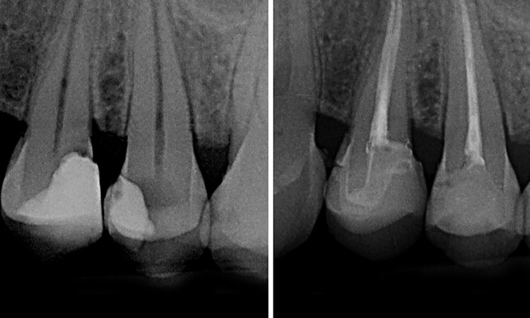 root-canal white filling
