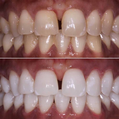 Oakdale-Teeth-Whitening $variable({"type":"content","value":{"name":"post_title","settings":{"before":"","after":""}}})$