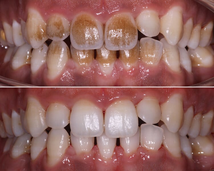 cleaning-stains2 dental hygienist leicester