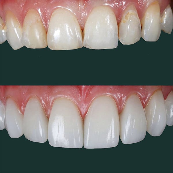 composite-bonding-leicester-1-1 $variable({"type":"content","value":{"name":"post_title","settings":{"before":"","after":""}}})$