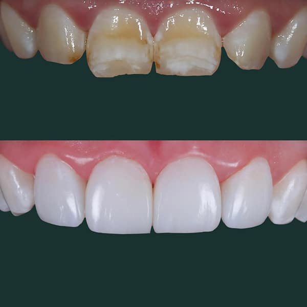 composite-bonding-leicester2-2 $variable({"type":"content","value":{"name":"post_title","settings":{"before":"","after":""}}})$