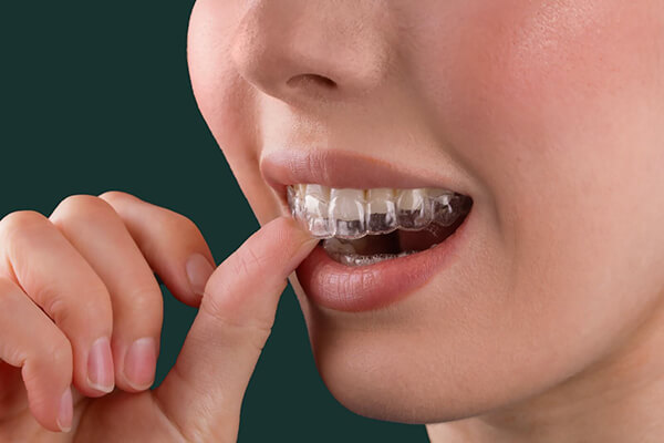 invisalign-braces-leicester $variable({"type":"content","value":{"name":"post_title","settings":{"before":"","after":""}}})$