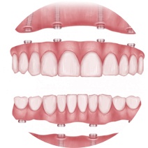 Multiple Tooth Replacement, Leicester Multiple Tooth Replacement, Leicester