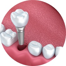 Single Tooth Replacement, Leicester Single Tooth Replacement, Leicester